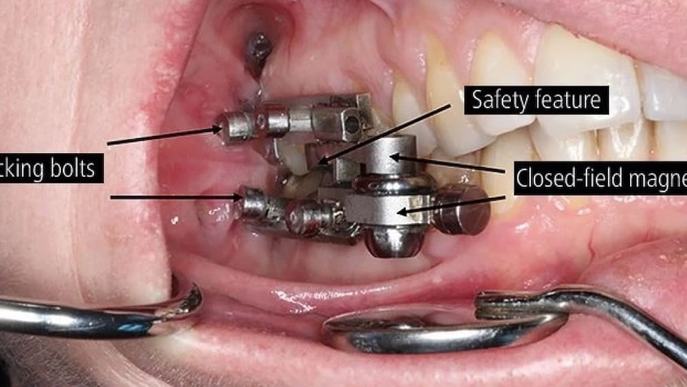 Weight loss thanks to locking the jaw: the dental magnet against obesity