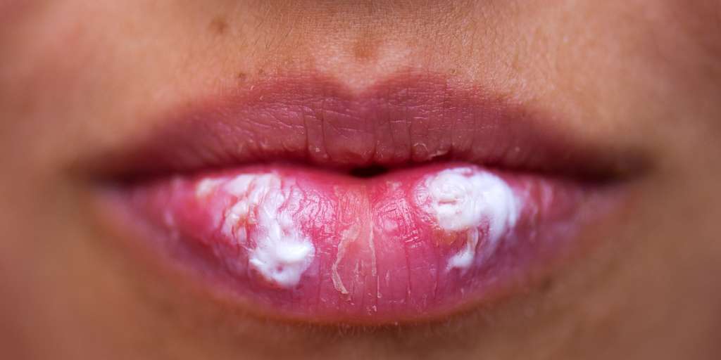 Cold sores - what to do?  Harmless but annoying infections