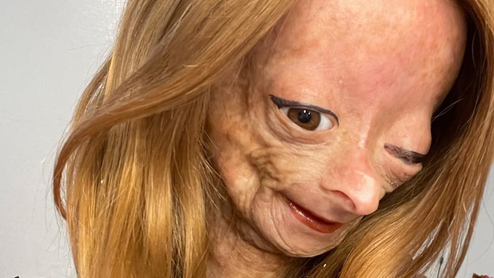 YouTube star Adalia Rose Williams suffers from a rare aging disease